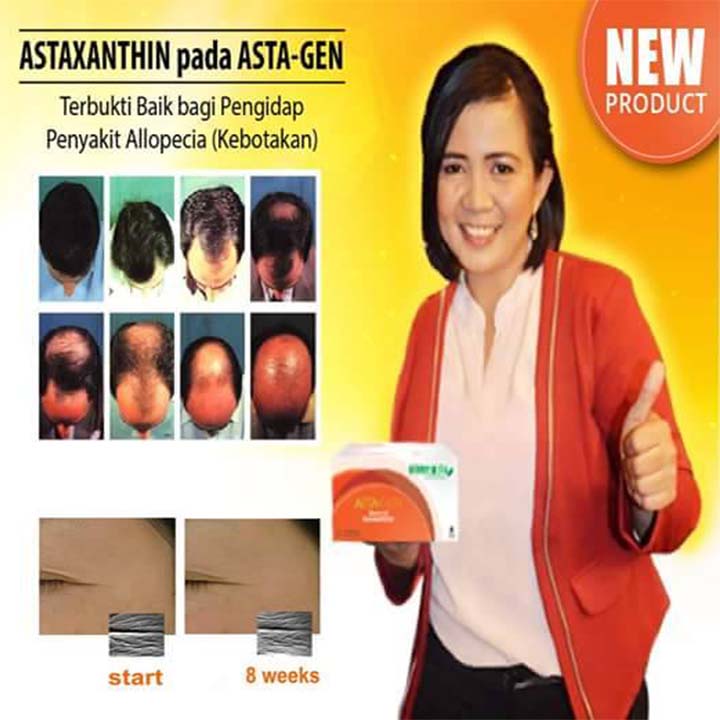 terapi-astagen-pada-kebotakan